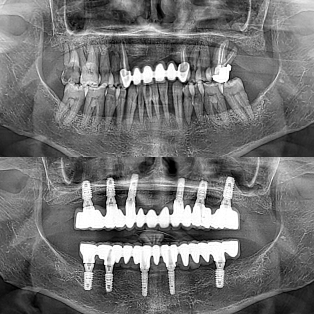 Implant Diş Fiyatları 2023
